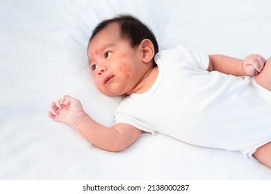 Close up face of newborn baby with atopic eczema on the cheek, concept of healthcare and skin dermatitis problem in the newborn baby with allergy of sensitive skin.