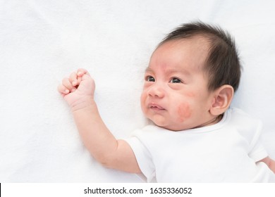 Close Up Face Of Newborn Baby With Eczema On The Cheek, Concept Of Healthcare And Skin Problem In The Newborn Baby.