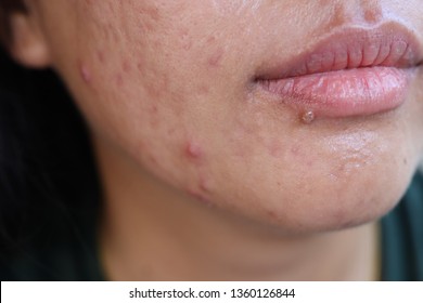 Close up the face skin Asian young women are acne, facial skin, acne, clogged scars caused by acne. Medical