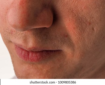 Close Up Face Of Young Man With Very Dry Skin. Problem Of Winter Season.