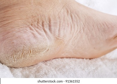 dry feet skin