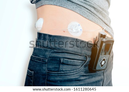 close up of a female diabetic patient with infusion insulin pump connected on the belly - medical device with wireless transmission technology - health care concept