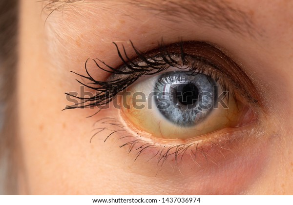 黄疸の黄色い強膜を持つ女性の目の接写 の写真素材 今すぐ編集