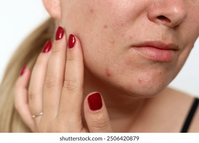 Close up of female face with red problematic acne skin and scars