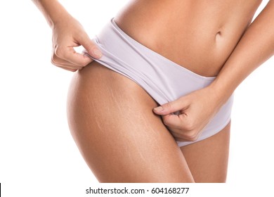 Close up of female hips with a stretch marks