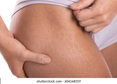 Close up of female hips with a stretch marks - Shutterstock ID 604168319