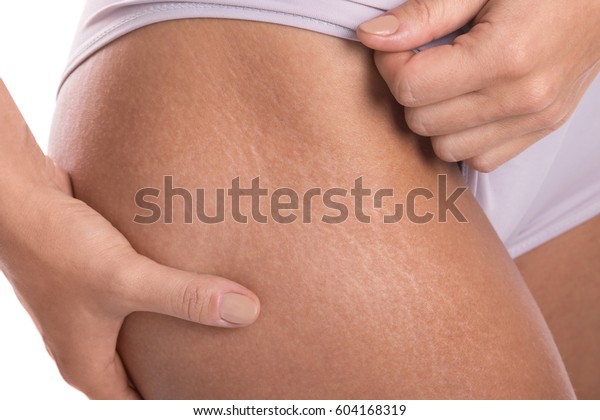Close up of female\
hips with a stretch marks