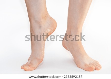 Close up of female legs with peeling skin of soles on heels. White background. Skin care concept.