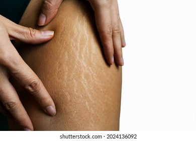 Close up female legs with stretch marks