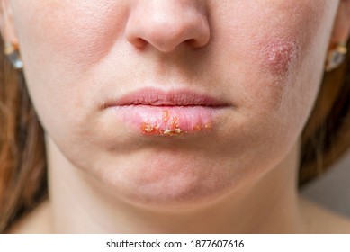 herpes female