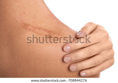Close up of female shoulder with a scar Imagine de stoc © 