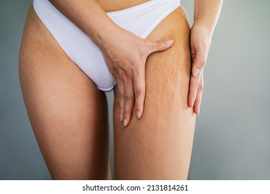 Close up female thighs with stretch marks