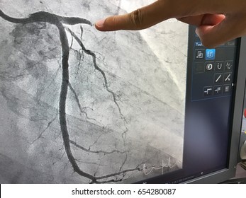 Close Up Finger Point Disease At Coronary Artery On Monitor