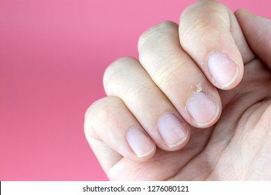 21 Nail Fold Infection Images, Stock Photos & Vectors | Shutterstock
