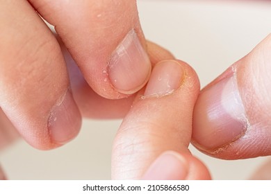 Close Up Of The Fingers Of A Hand With Nails And Cuticles In Bad Condition. Bad Habit Of Breaking Nails And Removing Cuticles. Concept Of Anxiety And Nervous Tics. Dry And Dehydrated Skin. 