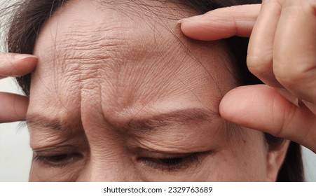 close up the flabbiness and flabby skin, Wrinkle and forehead lines, Dullness and dark spots, cellulite and bag under the eye, ptosis beside the eyelid on the face, health care and beauty concept.