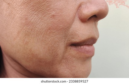 close up the flabbiness and wrinkle beside the mouth, Flabby skin, dark spots and rough skin, blemish, the mouth dry skin, freckles and pore on the face of the woman, health care and beauty concept.
