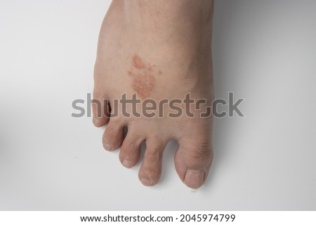 close up of foot infected with ringworm, athlete's foot or tinea pedis fungal infection. on white background.