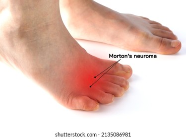Close up foot isolated on white background with red area explain to Morton's neuroma pinched nerve, the pain in between the toes in metatarsal bones while walking. Pain in between the toes.