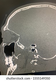 Close Fracture At Lateral Wall Of Right Sphenoid Sinus With Hemosinus , Subtle Brain Edema Of Right Medial Temporal Lobe , Saggital View