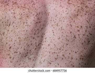 Close Up Of Freckles On Back Of Woman. Sensitive Skin Texture