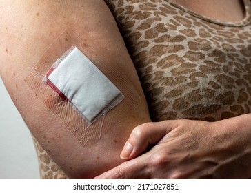 Close Up Of A Fresh Arm Wound Covered In Surgical Plaster Following Surgery To Remove A Cancerous Melanoma Mole