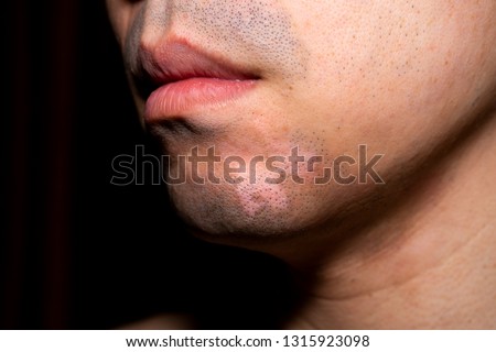 Close up front view of Asian man with Vitiligo. Abnormal skin Melanocyte Pigment.