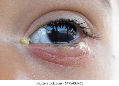 A close up and front view on the eye of a preschool child suffering from bacterial conjunctivitis, causing teary eyes and weeping crusty pus, fighting infection.