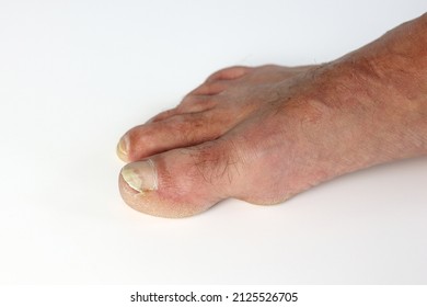 Close up fungus toenail disease, the fungus infects the areas between toes and the skin of the feet, it's called athlete's foot (tinea pedis) or Nail fungus disease or onychomycosis 