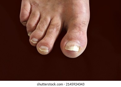 Close up fungus toenail disease on man toenail, the fungus infects the areas between toes and the skin of the feet, it's called athlete's foot (tinea pedis) or Nail fungus disease or onychomycosis 