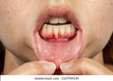 Close up of gum disease recession on lower teeth