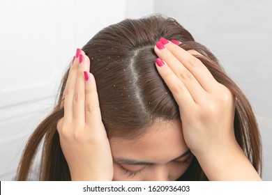 Close Up Hair Dandruff On Brown Female Hair.