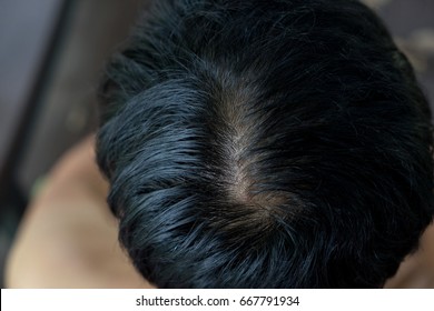 Close Up Hair Loss, Thinning Hair And Scalp Issue. Hair Loss Treatment.head With Loss Symptoms. Bald Treatment. Bald Hair Of Male Heredity