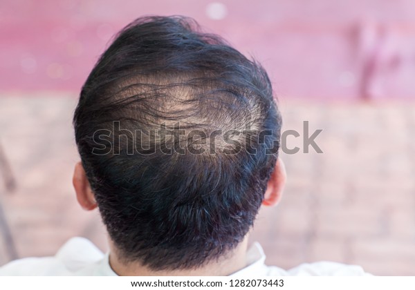 Close Hair Loss Thinning Hair Scalp Stock Photo Edit Now 1282073443