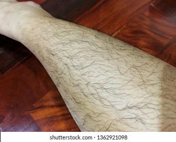 Close Up Hairy Leg Of Asian Woman Because Androgenic Effect In Female Who Has High Level Of Androgen Hormone (Hyperandrogenism) Call Hirsutism That Is Condition In Woman Develop Excessive Hair Growth 