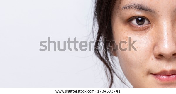 Close up half fresh face of Asian\
women is looking at camera on white banner background with copy\
space, Problem skin face, Freckle on face of Asian women,\
