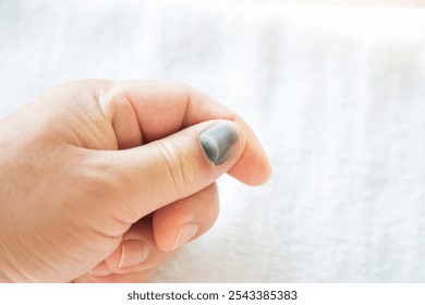 Close up of hand with bruised thumbnail, showing injury and pain. - Powered by Shutterstock