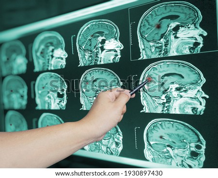 Close up Hand doctor point brian scan image of a recent traumatic brain injury patient showing brain contusion and hemorrhage.Medical image concept.