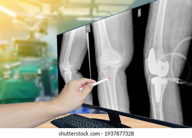 Close up hand Doctor point Image X-ray knee replacement with blurred background of surgical team performing surgery in operating room. Medical technology concept. - Powered by Shutterstock