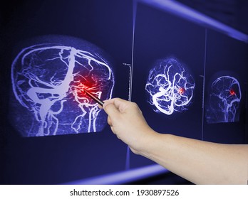 Close Up Hand Doctor Point MRA Brian Scan Image Of A Recent Traumatic Brain Injury Patient Showing Brain Contusion And Hemorrhage.Medical Image Concept.