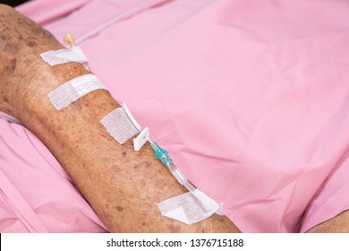 Close Up Hand Of Elderly Over 80 S Asian Man Patient With Intravenous Catheter For Injection Plug, Saline Transfusion Or Brine Drip During The Chemotherapy Of Liver Cancer In Hospital Ward Room

