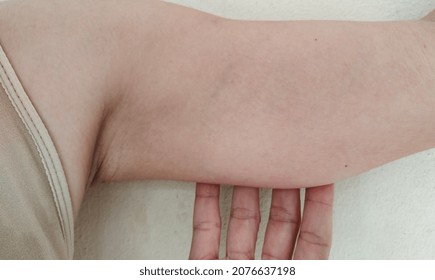 Close Up The Hand Holding The Sagging Skin Under The Arm, Black Armpit, Problem Skin.