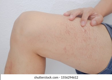 Cold Rash Stock Photos Images Photography Shutterstock