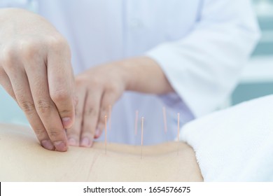 Close Up Hand Of Therapist Giving Acupuncture Treatment Or Sticks Needles Treatment Into Low Back Pain Woman. Young Woman Getting Acupuncture Treatment In Therapy Room. Medical And Health Concept