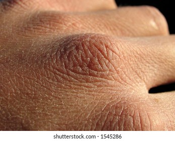 Close Up Of Hand With Very Dry Skin And Deep Cracks On Knuckles