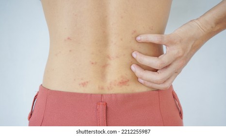 Close Up Of The Hand Of A Woman Scratching Her Back With An Allergic Rash. Dermatitis, Itchy Skin, Food Allergy, Skin Disease, Allergic Rash With Red Spots On The Back Of A Woman. Health Care Concept