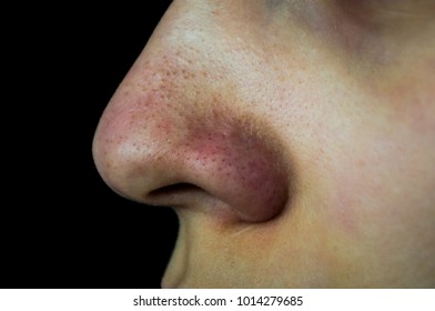 Close Up Has Skin Problem, Large Pores, Whitehead And Blackhead Pimple