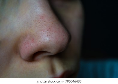 Close Up Has Skin Problem, Large Pores, Whitehead And Blackhead Pimple