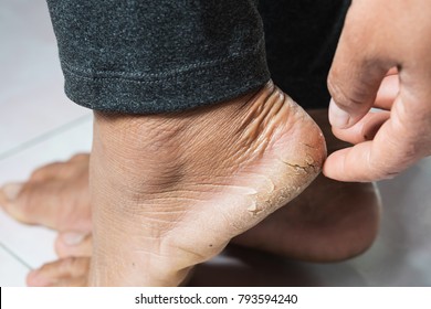 cracks in foot sole