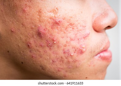 Close Up Of Hormonal Acne In Man Face. Right Side.